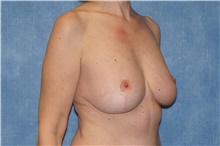 Breast Reduction After Photo by George John Alexander, MD, FACS; ,  - Case 46253
