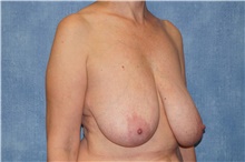 Breast Reduction Before Photo by George John Alexander, MD, FACS; ,  - Case 46253