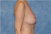 Mommy Makeover After Photo by George John Alexander, MD, FACS; ,  - Case 46312