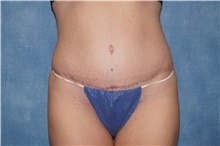 Tummy Tuck After Photo by George John Alexander, MD, FACS; ,  - Case 46313