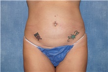 Tummy Tuck Before Photo by George John Alexander, MD, FACS; Las Vegas, NV - Case 46313