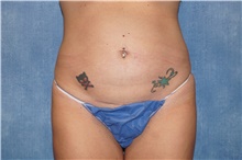 Tummy Tuck Before Photo by George John Alexander, MD, FACS; ,  - Case 46313