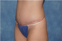 Tummy Tuck After Photo by George John Alexander, MD, FACS; ,  - Case 46313