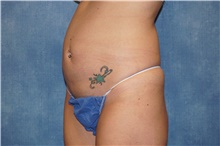 Tummy Tuck Before Photo by George John Alexander, MD, FACS; ,  - Case 46313