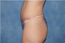 Tummy Tuck After Photo by George John Alexander, MD, FACS; ,  - Case 46313