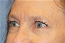 Brow Lift Before Photo by George John Alexander, MD, FACS; ,  - Case 46314