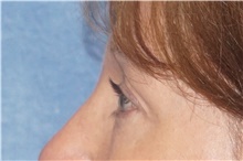 Brow Lift After Photo by George John Alexander, MD, FACS; ,  - Case 46314