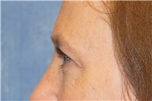 Brow Lift Before Photo by George John Alexander, MD, FACS; ,  - Case 46314
