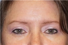 Eyelid Surgery After Photo by George John Alexander, MD, FACS; ,  - Case 46315