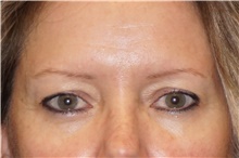 Eyelid Surgery Before Photo by George John Alexander, MD, FACS; ,  - Case 46315