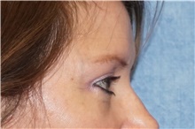 Eyelid Surgery After Photo by George John Alexander, MD, FACS; Las Vegas, NV - Case 46315