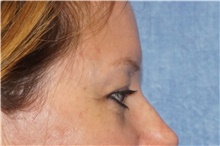 Eyelid Surgery Before Photo by George John Alexander, MD, FACS; Las Vegas, NV - Case 46315