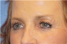 Brow Lift Before Photo by George John Alexander, MD, FACS; Las Vegas, NV - Case 46316