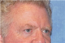 Brow Lift Before Photo by George John Alexander, MD, FACS; ,  - Case 46317