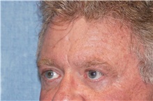 Brow Lift After Photo by George John Alexander, MD, FACS; ,  - Case 46317