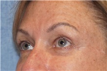 Brow Lift After Photo by George John Alexander, MD, FACS; ,  - Case 46318