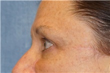 Brow Lift Before Photo by George John Alexander, MD, FACS; ,  - Case 46318