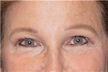 Brow Lift After Photo by George John Alexander, MD, FACS; ,  - Case 46319