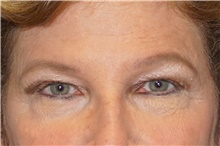 Brow Lift Before Photo by George John Alexander, MD, FACS; ,  - Case 46319