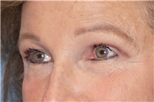Brow Lift After Photo by George John Alexander, MD, FACS; ,  - Case 46319