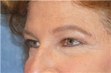 Brow Lift Before Photo by George John Alexander, MD, FACS; ,  - Case 46319