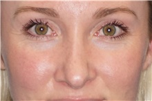 Rhinoplasty After Photo by George John Alexander, MD, FACS; ,  - Case 46324