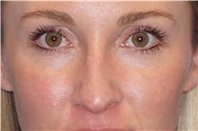 Rhinoplasty Before Photo by George John Alexander, MD, FACS; ,  - Case 46324