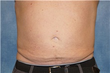 Liposuction Before and After Pictures Case 101, Gilbert, AZ