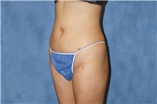 Liposuction After Photo by George John Alexander, MD, FACS; Las Vegas, NV - Case 46334
