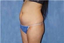 Liposuction Before Photo by George John Alexander, MD, FACS; Las Vegas, NV - Case 46334
