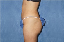 Liposuction After Photo by George John Alexander, MD, FACS; ,  - Case 46334