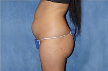 Liposuction Before Photo by George John Alexander, MD, FACS; ,  - Case 46334