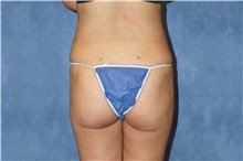 Liposuction After Photo by George John Alexander, MD, FACS; ,  - Case 46334