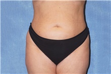 Liposuction After Photo by George John Alexander, MD, FACS; Las Vegas, NV - Case 46338
