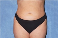 Liposuction After Photo by George John Alexander, MD, FACS; ,  - Case 46338