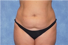 Liposuction Before Photo by George John Alexander, MD, FACS; ,  - Case 46338