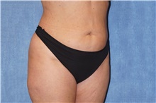 Liposuction After Photo by George John Alexander, MD, FACS; ,  - Case 46338