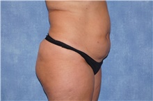 Liposuction Before Photo by George John Alexander, MD, FACS; ,  - Case 46338