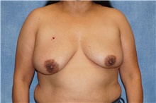Breast Implant Removal After Photo by George John Alexander, MD, FACS; Las Vegas, NV - Case 46345