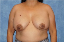 Breast Implant Removal Before Photo by George John Alexander, MD, FACS; Las Vegas, NV - Case 46345