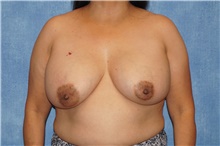 Breast Implant Removal Before Photo by George John Alexander, MD, FACS; ,  - Case 46345