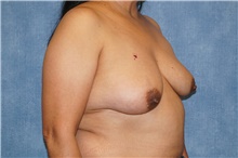 Breast Implant Removal After Photo by George John Alexander, MD, FACS; ,  - Case 46345