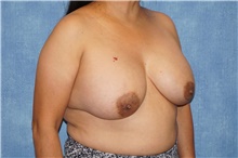 Breast Implant Removal Before Photo by George John Alexander, MD, FACS; ,  - Case 46345