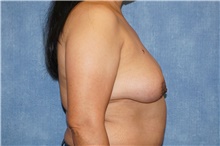 Breast Implant Removal After Photo by George John Alexander, MD, FACS; ,  - Case 46345