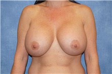 Breast Implant Revision After Photo by George John Alexander, MD, FACS; Las Vegas, NV - Case 46347