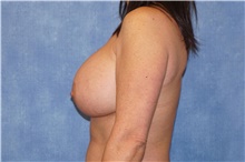 Breast Implant Revision Before Photo by George John Alexander, MD, FACS; Las Vegas, NV - Case 46347