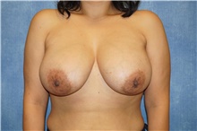 Breast Implant Revision After Photo by George John Alexander, MD, FACS; Las Vegas, NV - Case 46348
