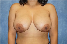 Breast Implant Revision After Photo by George John Alexander, MD, FACS; ,  - Case 46348