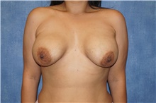Breast Implant Revision Before Photo by George John Alexander, MD, FACS; Las Vegas, NV - Case 46348