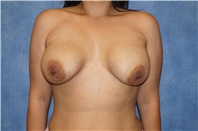 Breast Implant Revision Before Photo by George John Alexander, MD, FACS; ,  - Case 46348